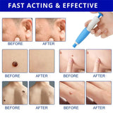 edistore, edistore.us, 2 In1 Painless Auto Skin Tag Mole Removal Kit Cleaning Tools Face Skin Care