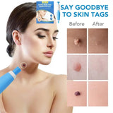 edistore, edistore.us, 2 In1 Painless Auto Skin Tag Mole Removal Kit Cleaning Tools Face Skin Care